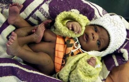 Zambia baby born with 4 legs in 2003.